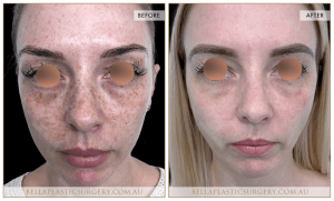 Freckles Patient 01 - 2