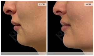 Chin Augmentation Patient 01 - 2