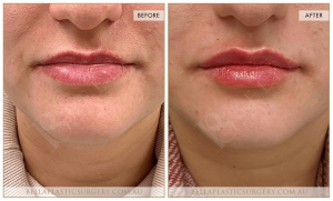 ‘Kiss Me’ Lip Augmentation 13 - 14