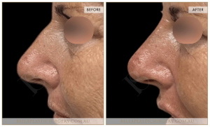 Non-Surgical Rhinoplasty 13 - 14
