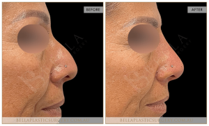 Non-Surgical Rhinoplasty 14 - 15