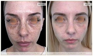 Skin Treatment 05 - 4