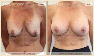 Revision Breast Patient 15 - 16
