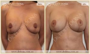 Revision Breast Patient 18 - 19