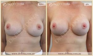 Revision Breast Patient 16 - 17