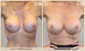 Revision Breast Patient 6 - 7