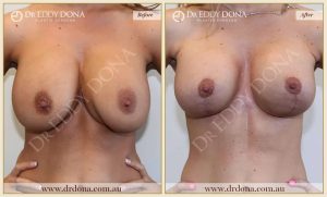 Revision Breast Patient 1 - 2