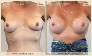 Revision Breast Patient 3 - 4