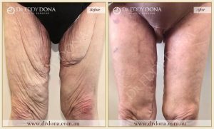 Thigh Lift 1 - 1