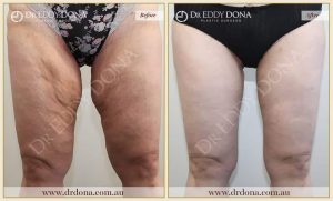 Thigh Lift 2 - 2